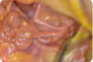 submandibular gland ecision